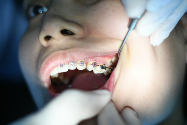 Un traitement orthodontique efficace à Nanterre pour tous